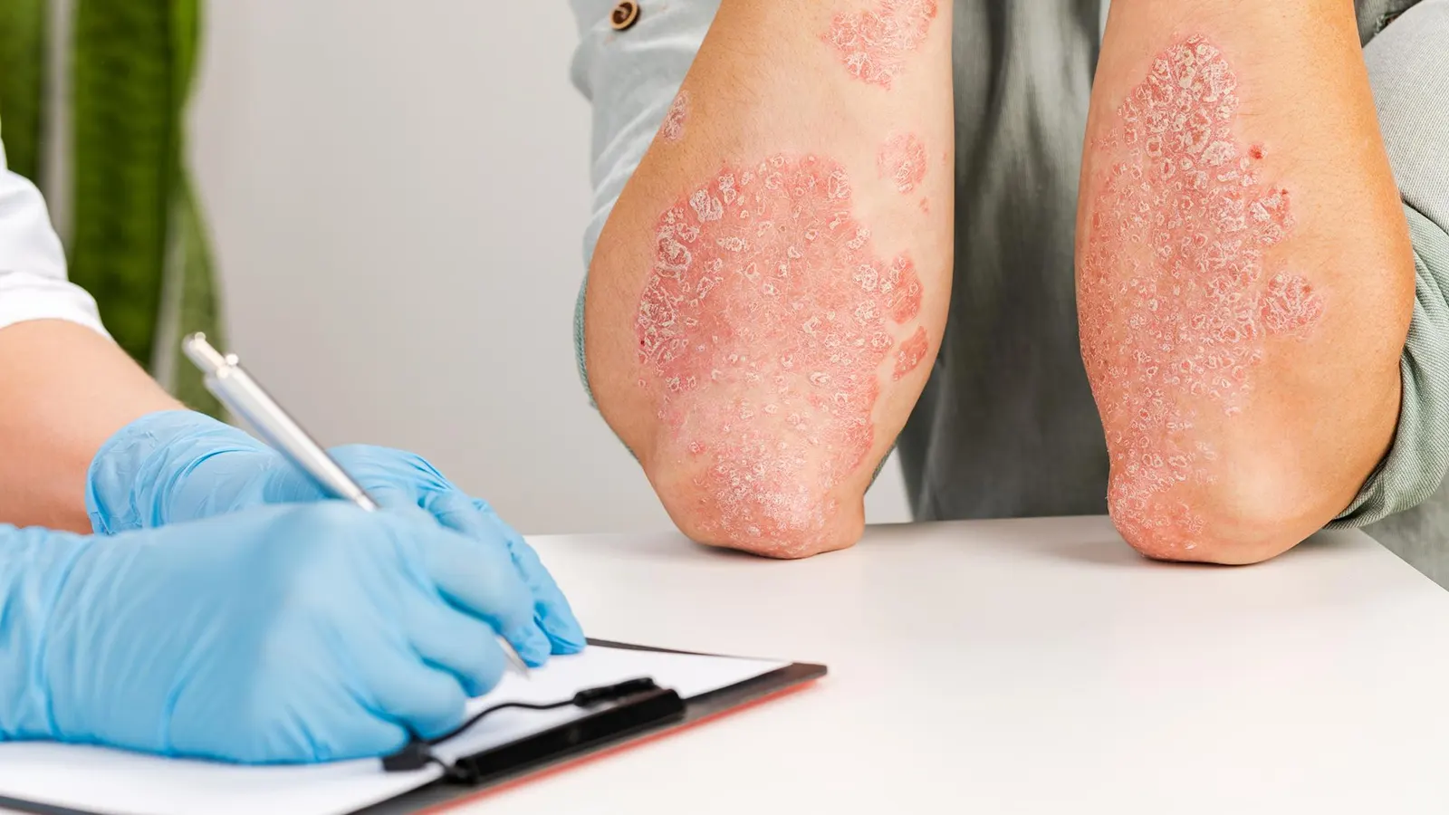 What is Behcet’s Disease?