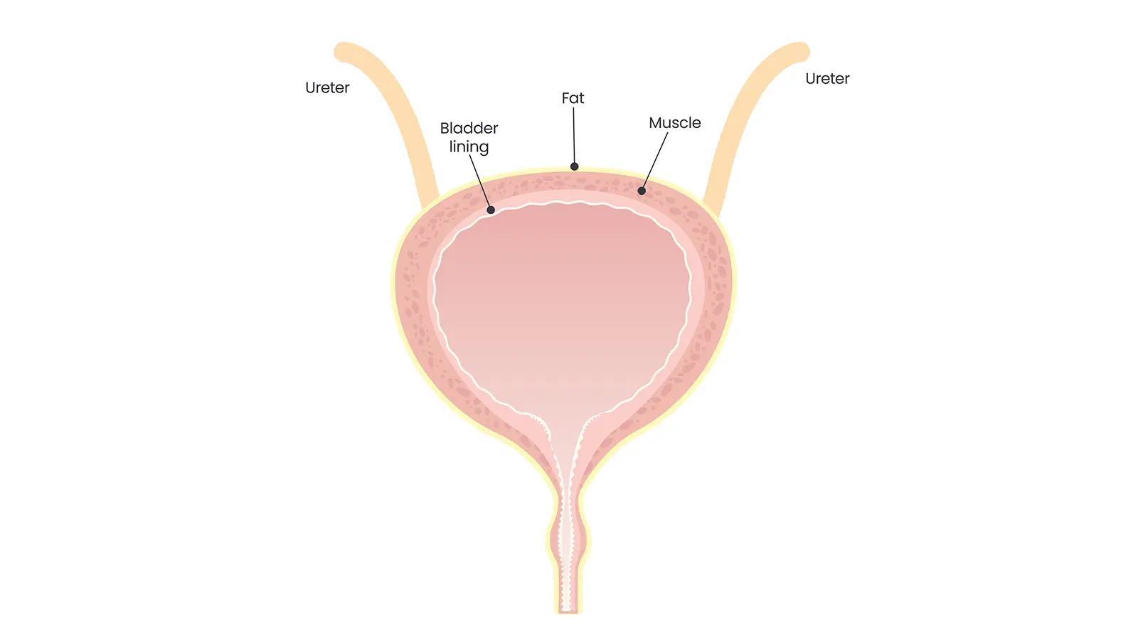 What is Bladder Wall Thickening?