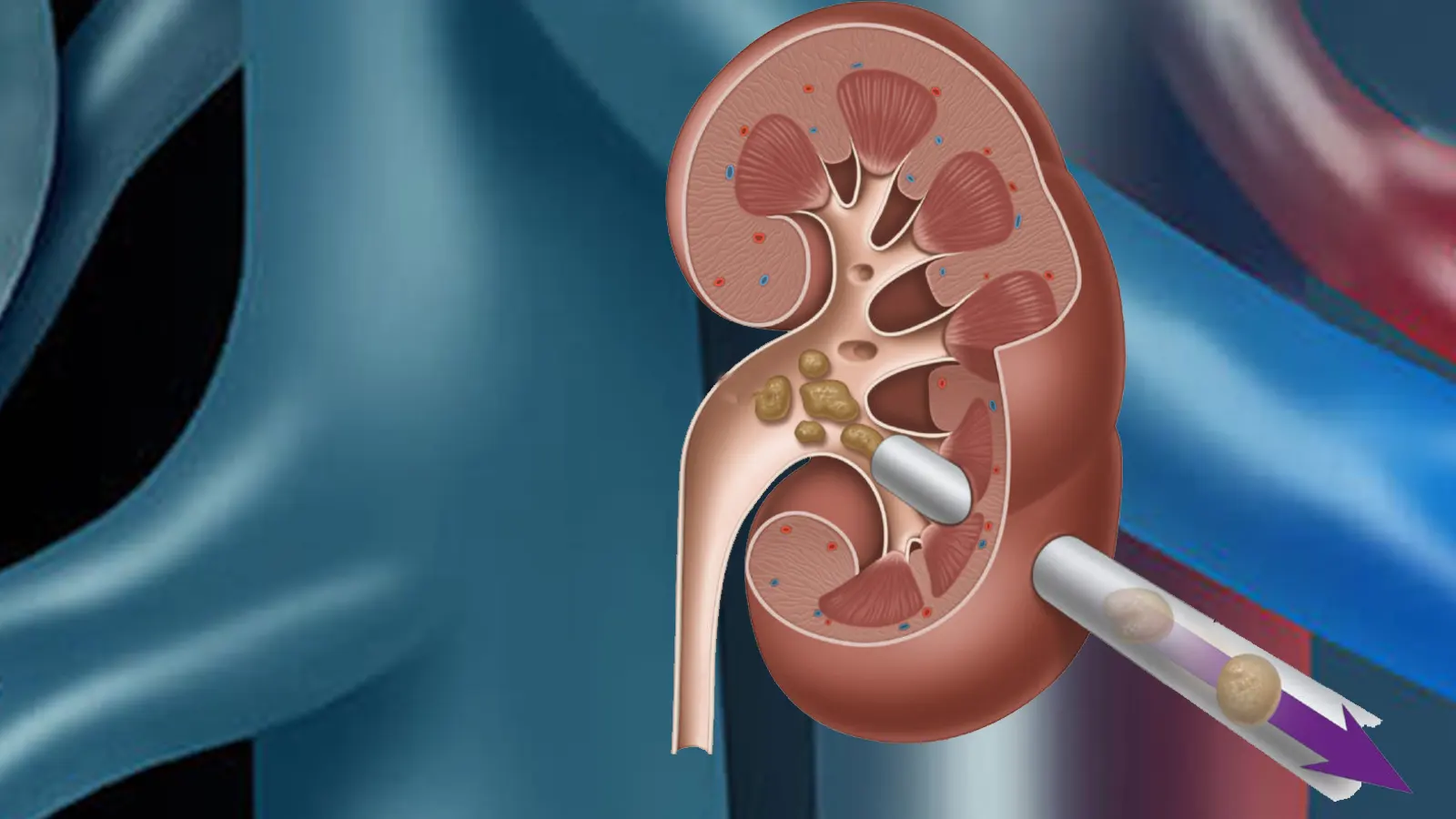 What is Percutaneous Nephrolithotomy (PNL)?